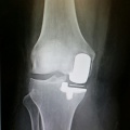 Schlittenprothese Knie